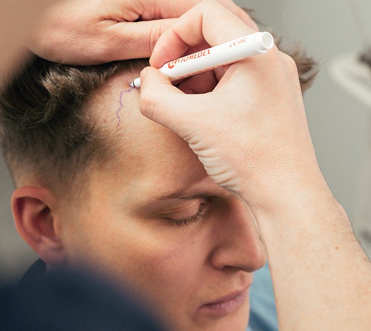 Anzeichnen der vorhandenen Haarlinie vor einer Haartransplantation bei SKINCREW® in Heidelberg und Frankenthal