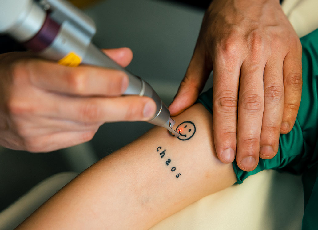 Tattooentfernung mittels Laser auf dem Arm