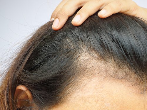 Haartransplantation bei Frauen bei hoher Stirn und Haarausfall